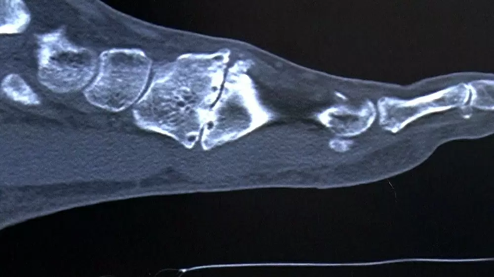 足の甲に痛みがある人は危険 リスフラン関節症とは 名医のthe太鼓判 Tbsテレビ