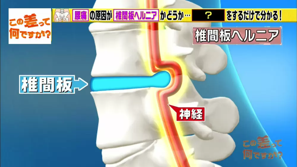 椎間板ヘルニアを簡単にセルフチェックしよう|この差って何ですか?|TBSテレビ