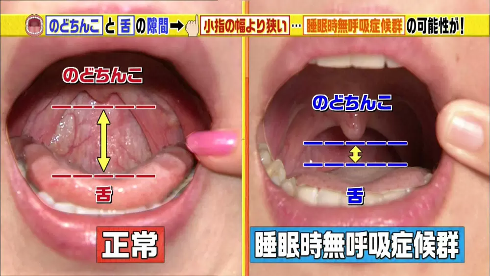 必要なのは鏡だけ 睡眠時無呼吸症候群 をセルフチェック Tbsテレビ 必要なのは鏡だけ 睡眠時無呼吸症候群 をセルフチェック Tbsテレビ