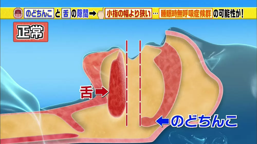 必要なのは鏡だけ 睡眠時無呼吸症候群 をセルフチェック Tbsテレビ 必要なのは鏡だけ 睡眠時無呼吸症候群 をセルフチェック Tbsテレビ