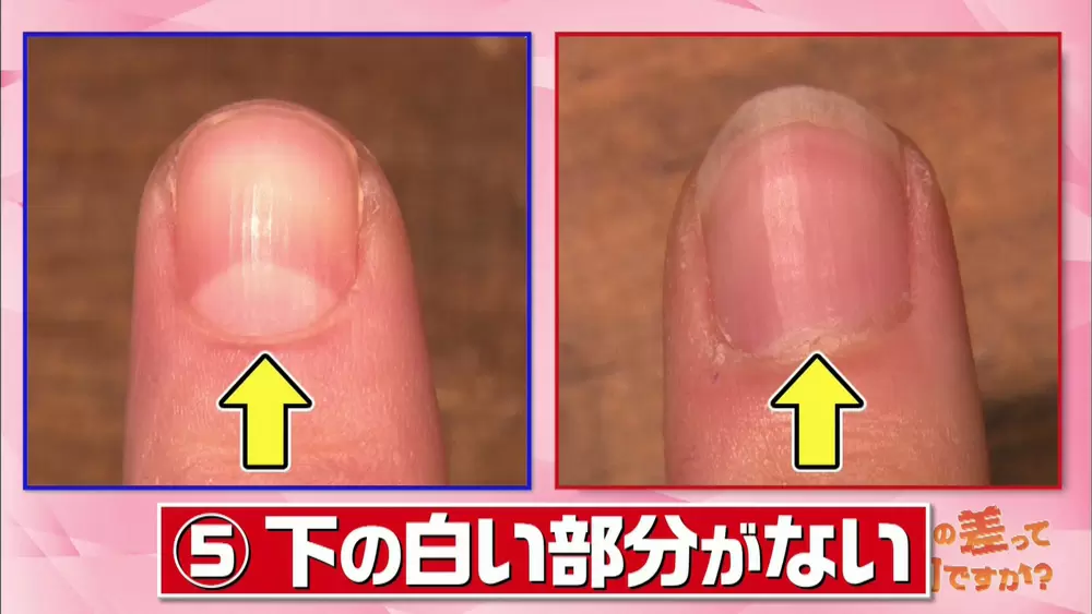 爪 に横線がある方 要注意です 健康セルフチェック Tbsテレビ