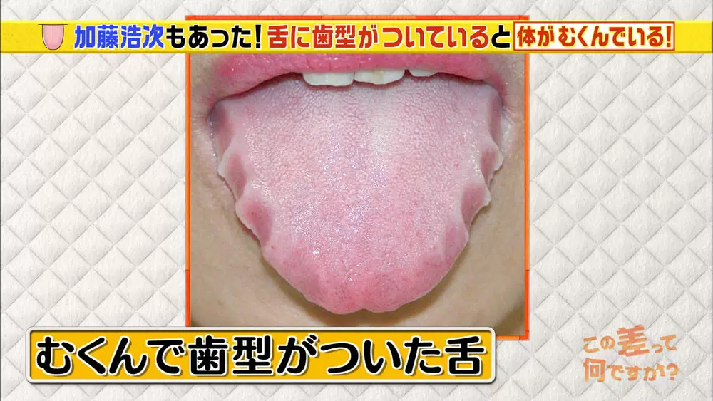 白い舌は胃腸のsos 舌でわかる健康学 Tbsテレビ