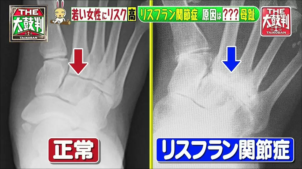 足の甲に痛みがある人は危険 リスフラン関節症とは 名医のthe太鼓判 Tbsテレビ 足の甲に痛みがある人は危険 リスフラン関節症とは 名医のthe太鼓判 Tbsテレビ