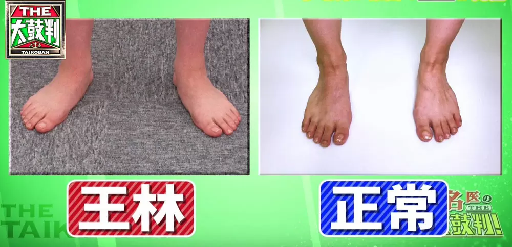 足にタコがある人は要注意 歩き方が腰痛の原因かも 名医のthe太鼓判 Tbsテレビ 足にタコがある人は要注意 歩き方が腰痛の原因かも 名医のthe太鼓判 Tbsテレビ
