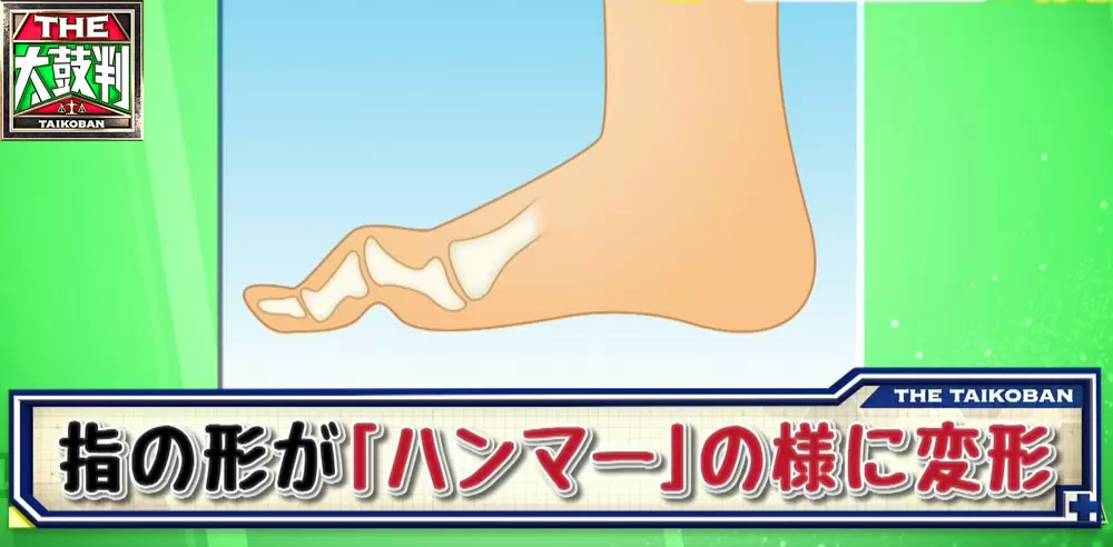 あなたは大丈夫 女性に多く見られる足のトラブル 原因 改善方法 名医のthe太鼓判 Tbsテレビ あなたは大丈夫 女性に多く見られる足のトラブル 原因 改善方法 名医のthe太鼓判 Tbsテレビ