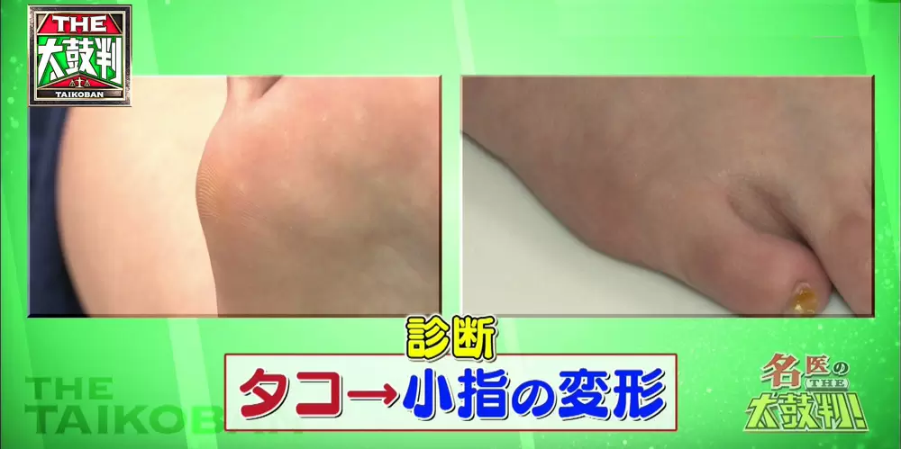 あなたは大丈夫 女性に多く見られる足のトラブル 原因 改善方法 名医のthe太鼓判 Tbsテレビ あなたは大丈夫 女性に多く見られる足のトラブル 原因 改善方法 名医のthe太鼓判 Tbsテレビ