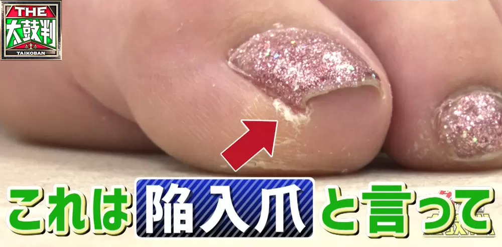 かかとが歪む 正しい歩き方できていますか 名医のthe太鼓判 Tbsテレビ