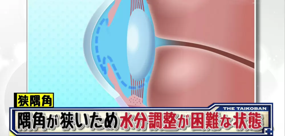狭隅角