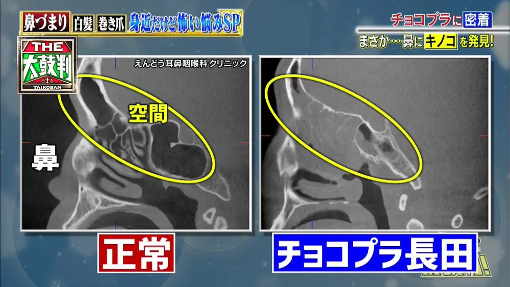 鼻の中に きのこ が生える 放っておくと危ない 鼻たけ とは 名医のthe太鼓判 Tbsテレビ 鼻の中に きのこ が生える 放っておくと危ない 鼻たけ とは 名医のthe太鼓判 Tbsテレビ