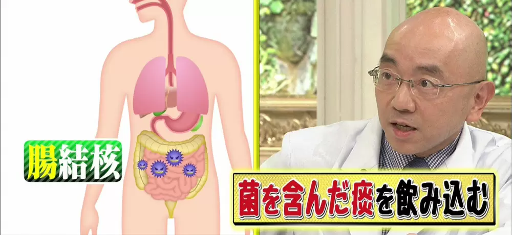 腸も結核になる?放置すると命に関わる「腸結核」とは名医のTHE太鼓判!|TBSテレビ