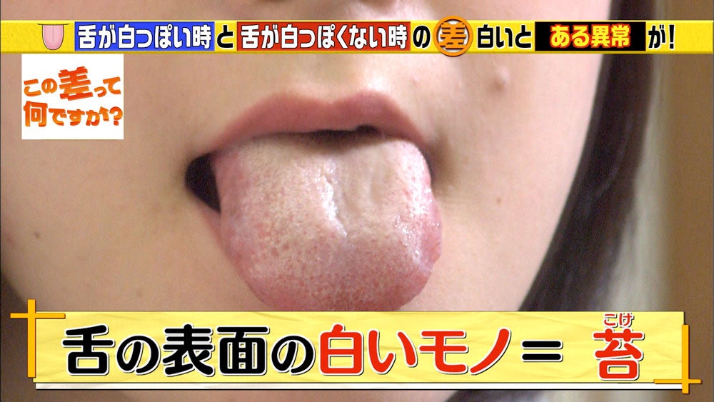 舌白い 取り方, 舌苔 奥の方だけ – EUGU